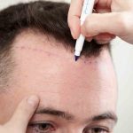 زراعة الشعر