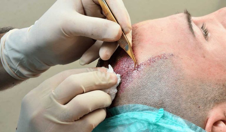 اضرار زراعة الشعر