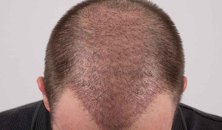 بعد زراعة الشعر بشهر