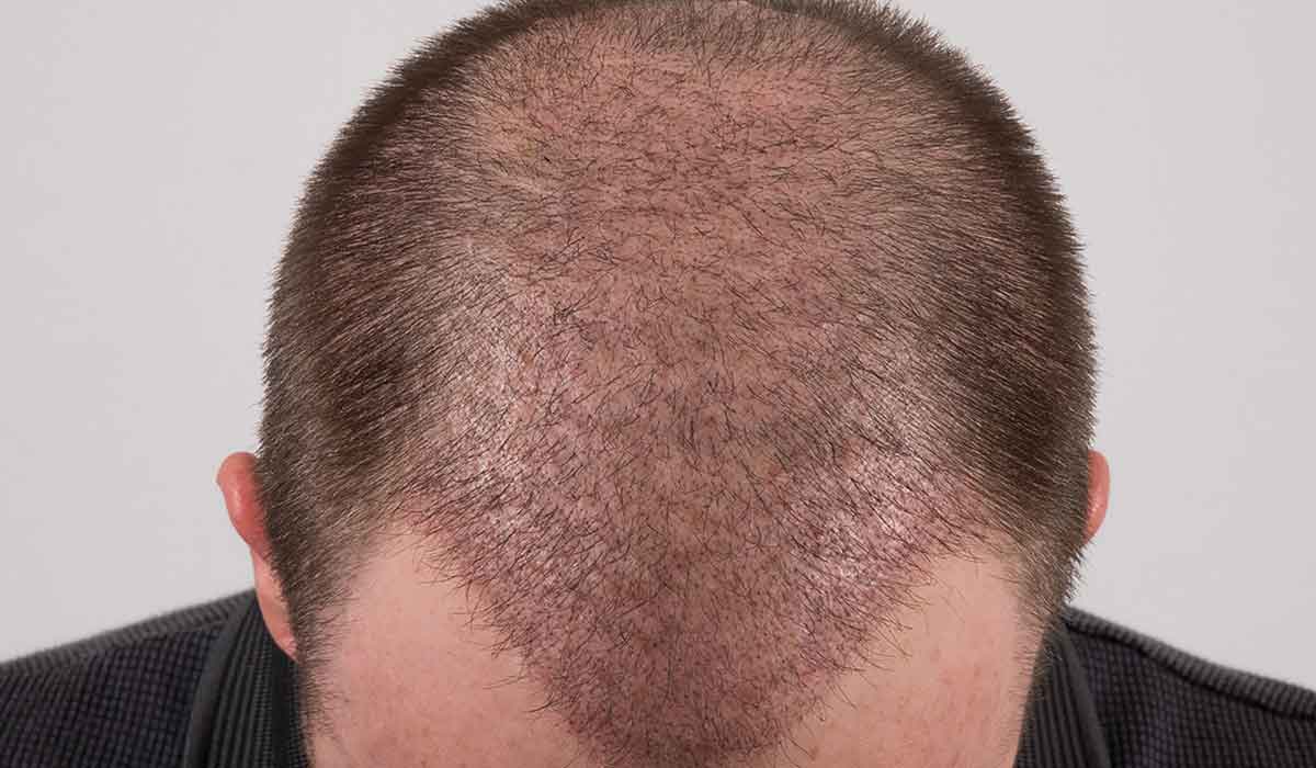 بعد زراعة الشعر بشهر
