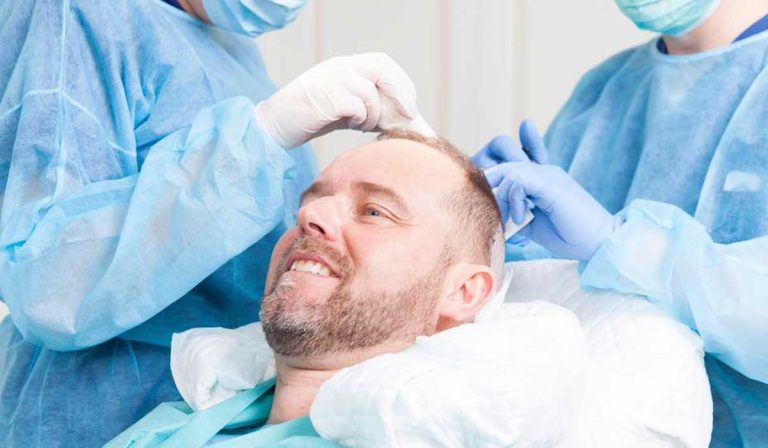بعد زراعة الشعر بشهرين