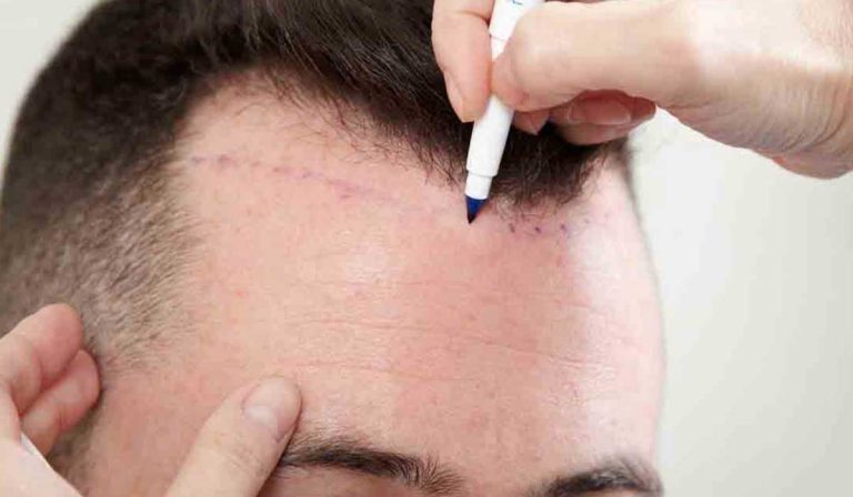 تكلفة زراعة الشعر