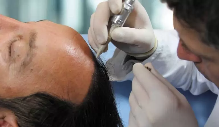 زراعة الشعر الصناعي