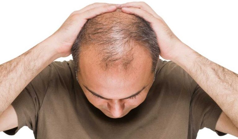 زراعة الشعر بالشريحة