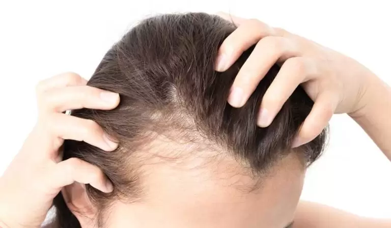 زراعة الشعر للنساء