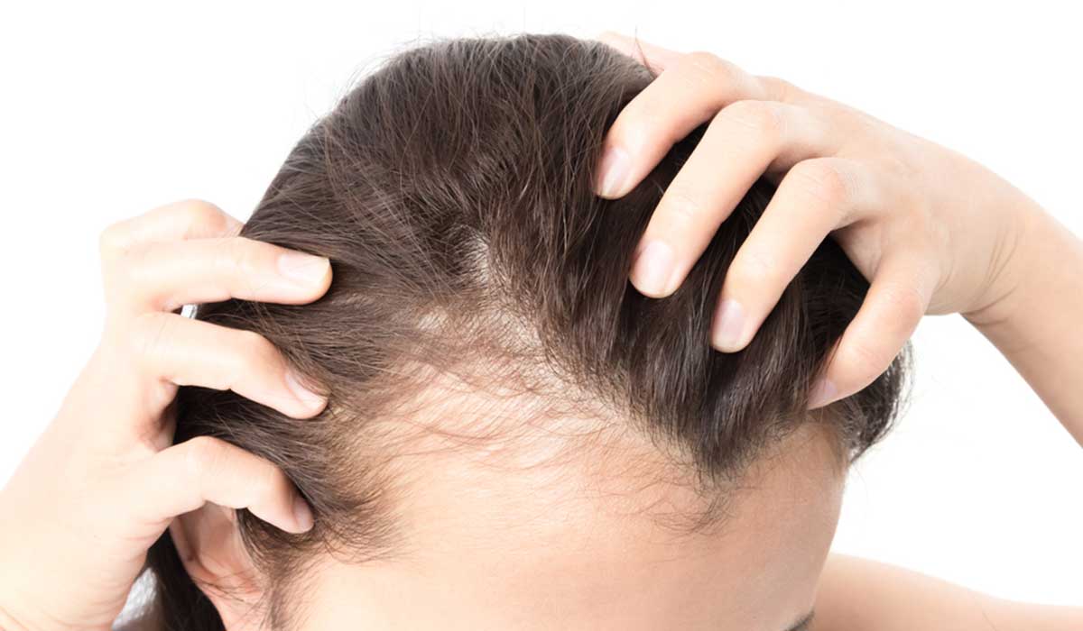 زراعة الشعر للنساء