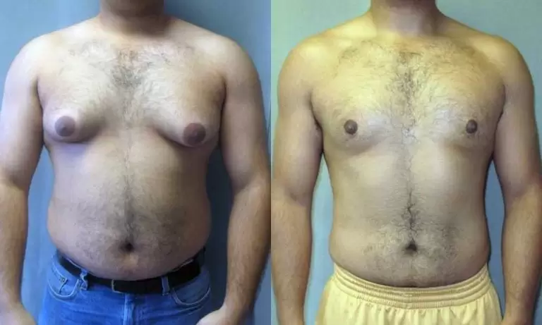 اختلاف حجم الثديين عند الرجال