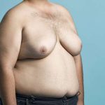 التثدي عند الرجال