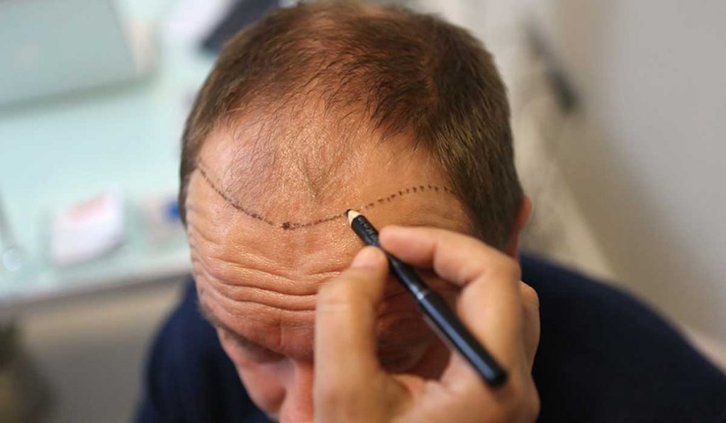 زراعة الشعر بالشريحة