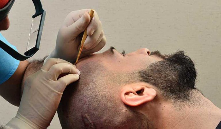 زرع الشعر بدون جراحة