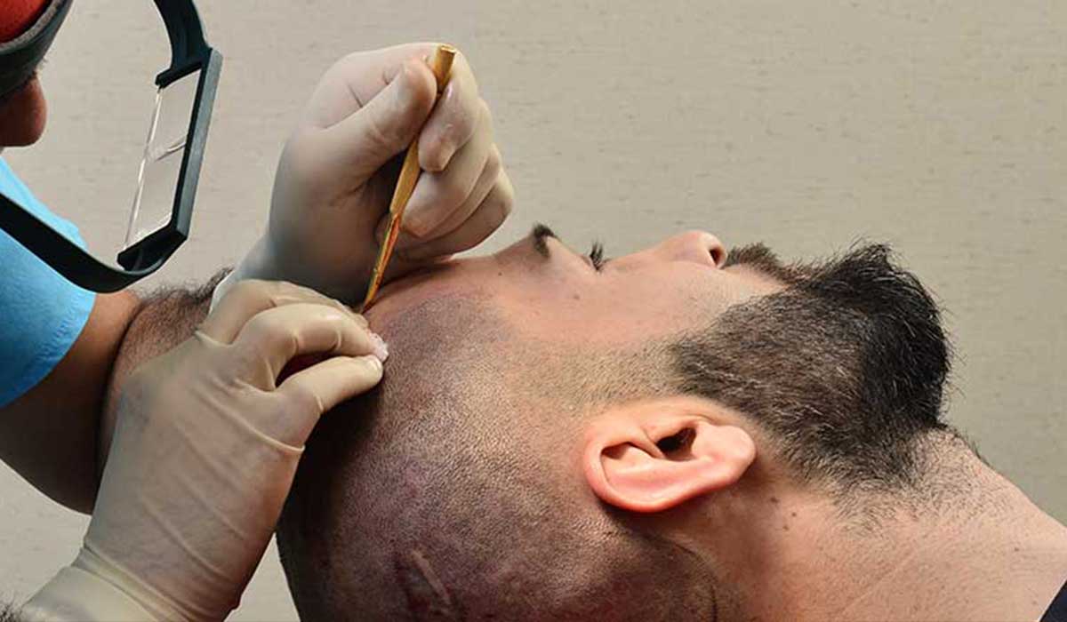 زرع الشعر بدون جراحة