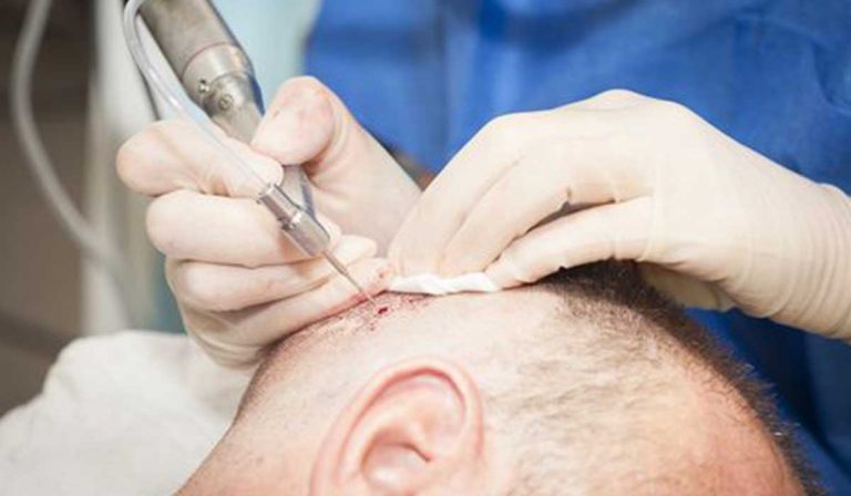 مراحل زراعة الشعر