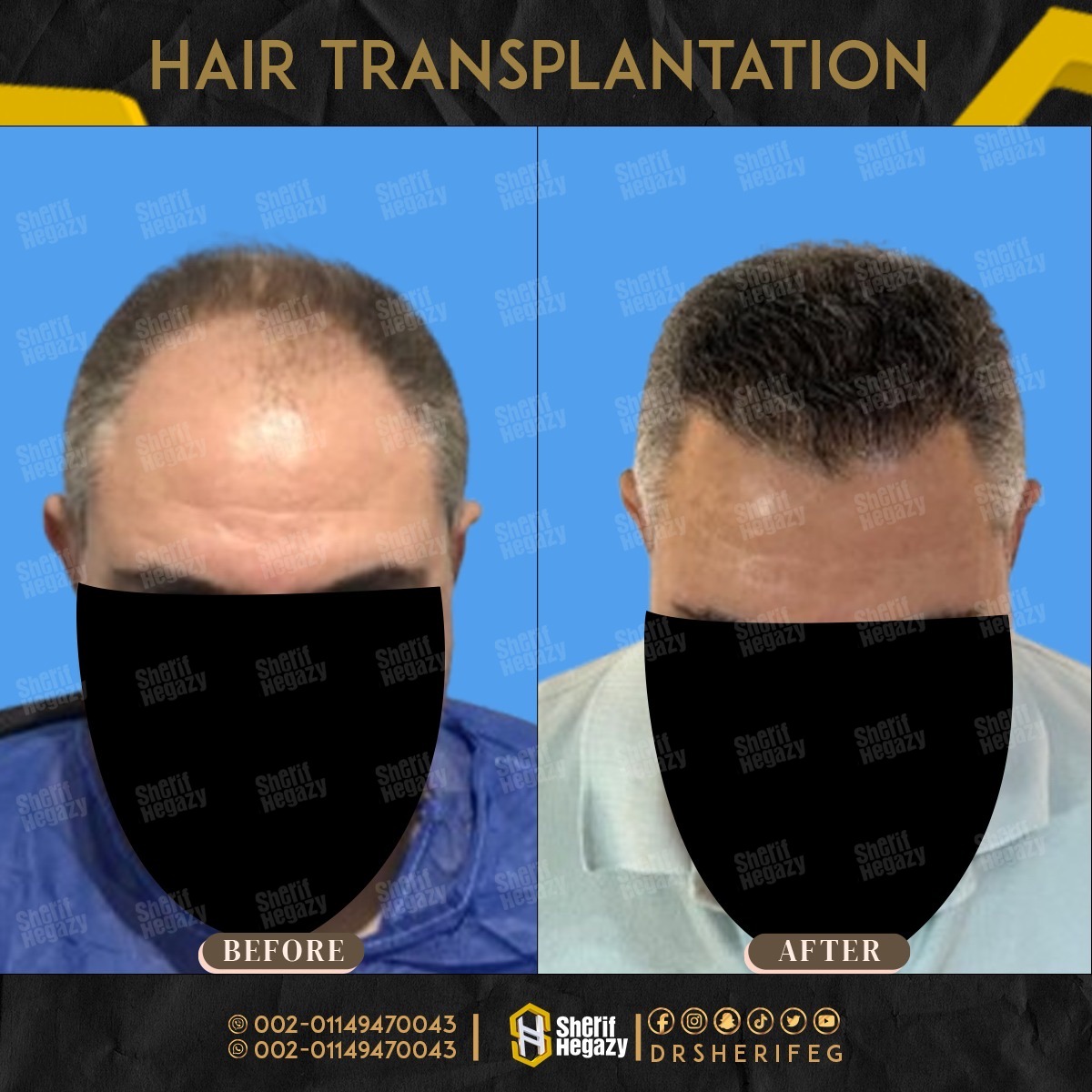 احدث علاج للصلع
