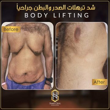 عملية شد البطن بالصور