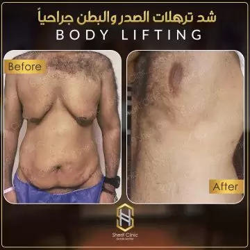 تجمع السوائل بعد عملية شد البطن