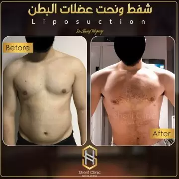 نحت البطن للرجال