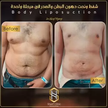 لبس المشد بعد عملية شفط الدهون