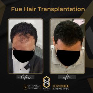 عدد بصيلات الشعر