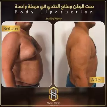 نحت الجسم قبل وبعد