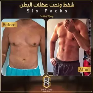 نحت البطن للرجال