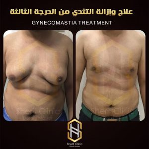 التثدى