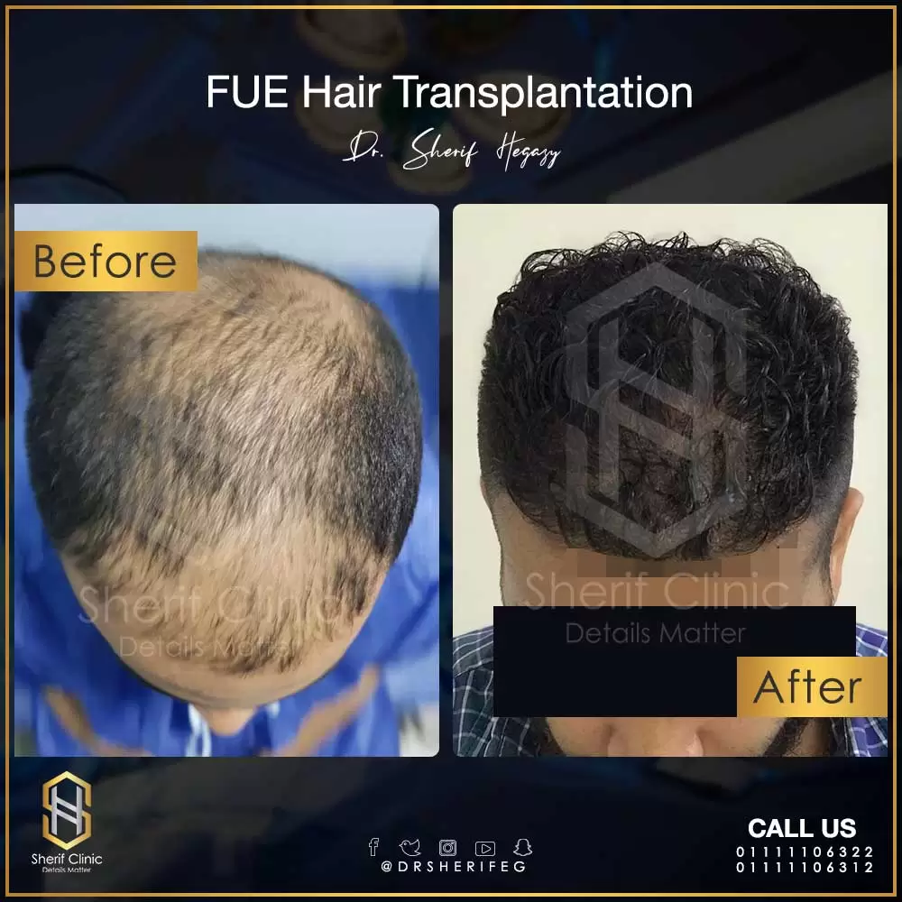 عملية زراعة الشعر