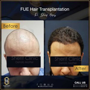 زراعة الشعر للرجال