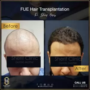 زراعة الشعر للرجال