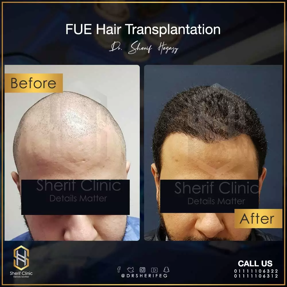 عملية زراعة الشعر