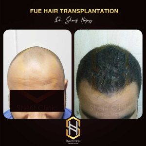 تكلفة زراعة الشعر