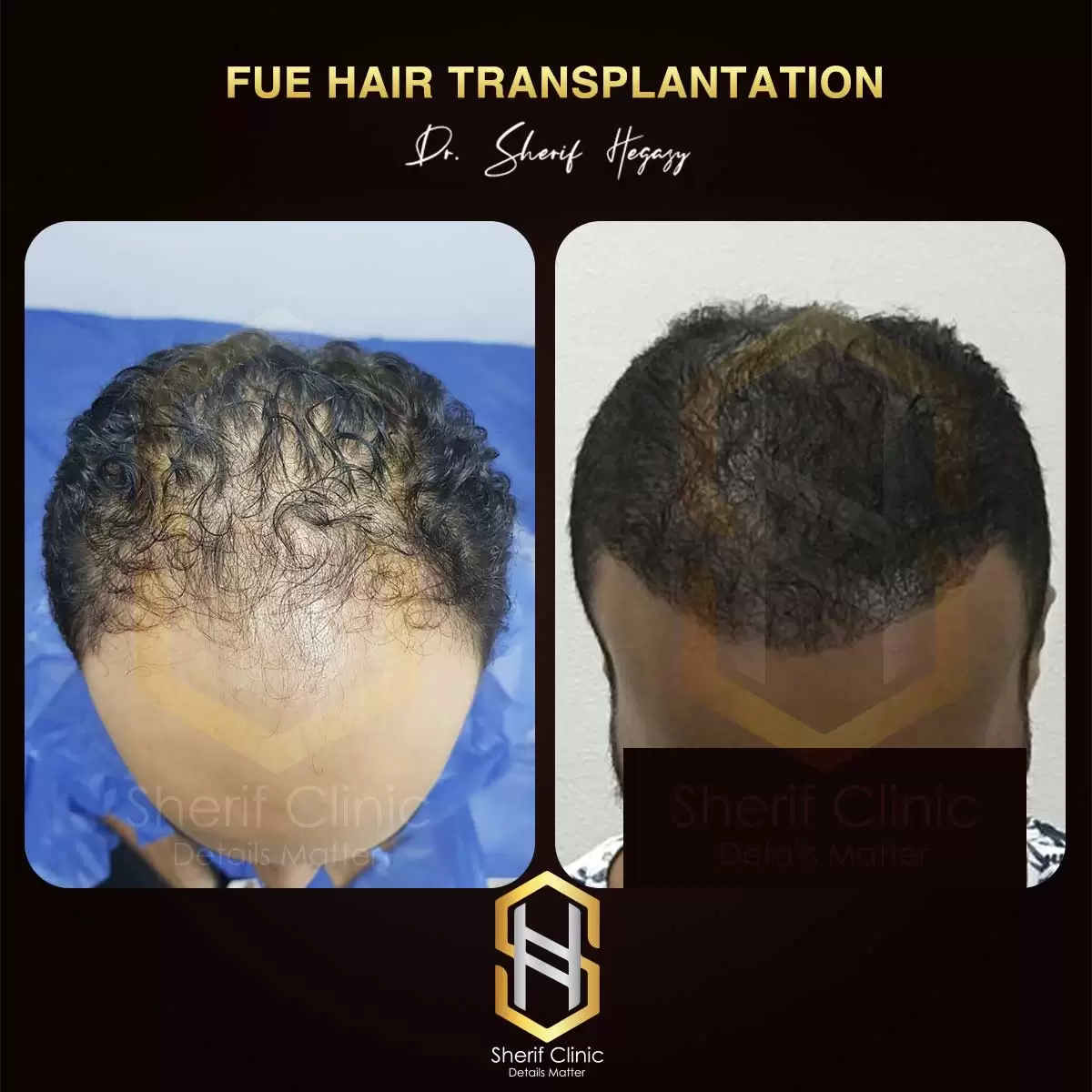 زراعة الشعر للرجال