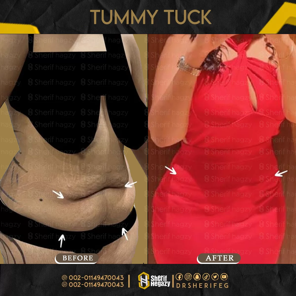 Tummy Tuck
