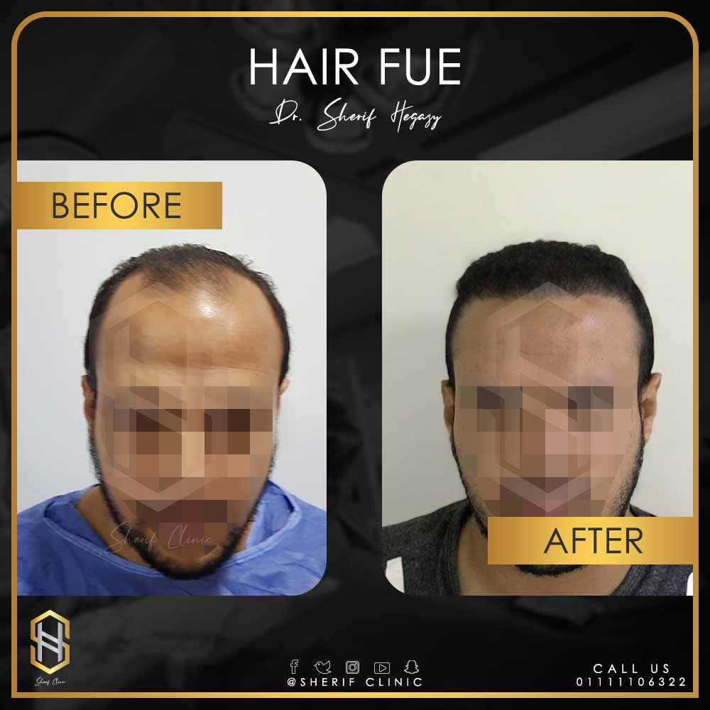 بعد زراعة الشعر بشهر