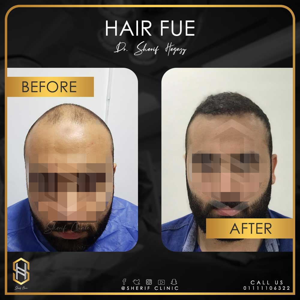 زراعة الشعر الطبيعي وأنواعها وخطواتها ونتائجها 2 زراعة الشعر الطبيعي