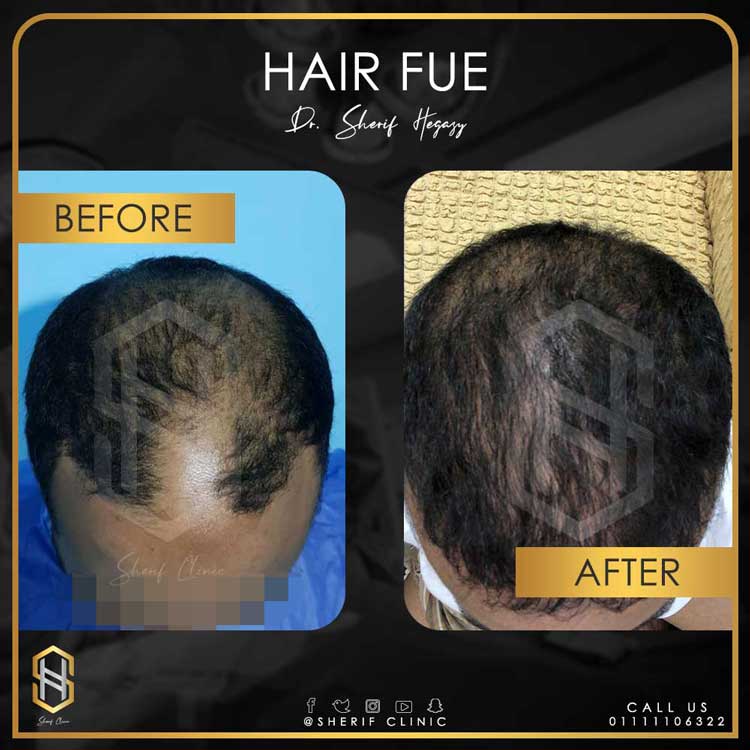 زراعة الشعر بالاقتطاف
