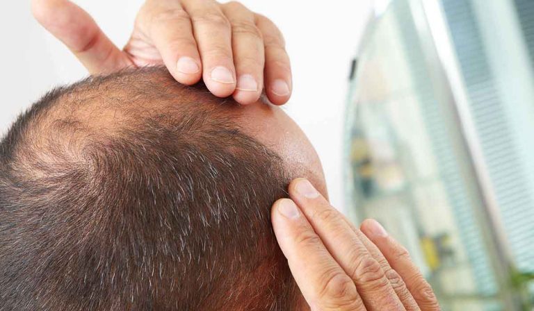 زراعة الشعر بالاقتطاف