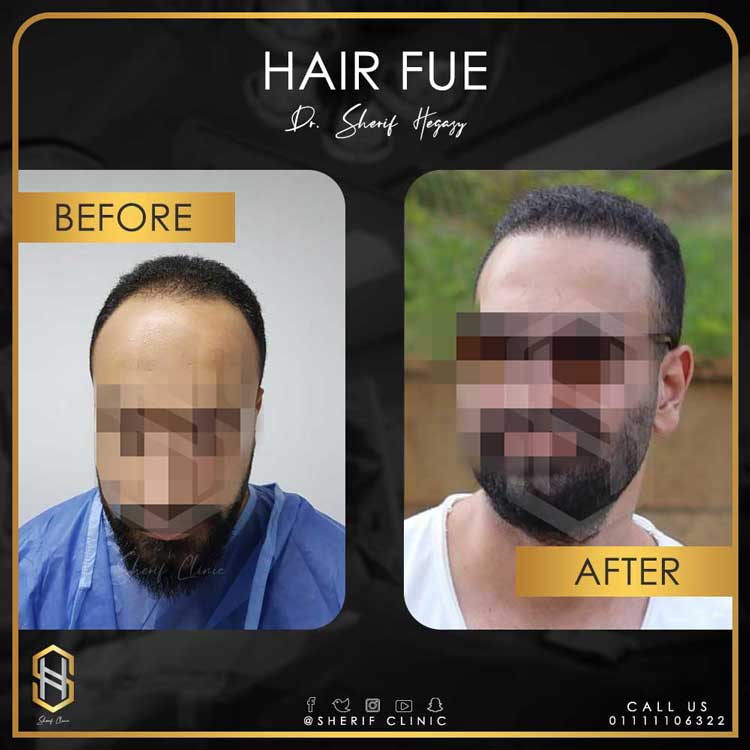 زراعة الشعر بالاقتطاف