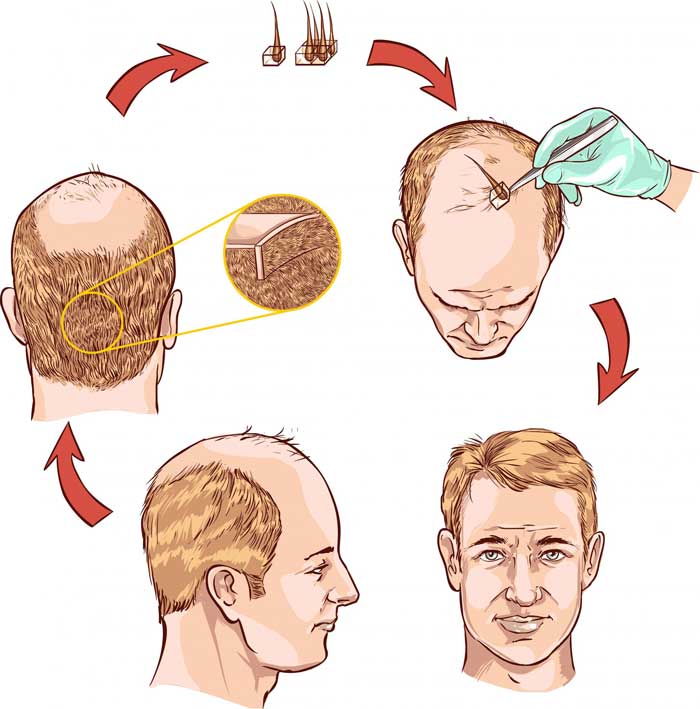 زراعة الشعر بالشريحة
