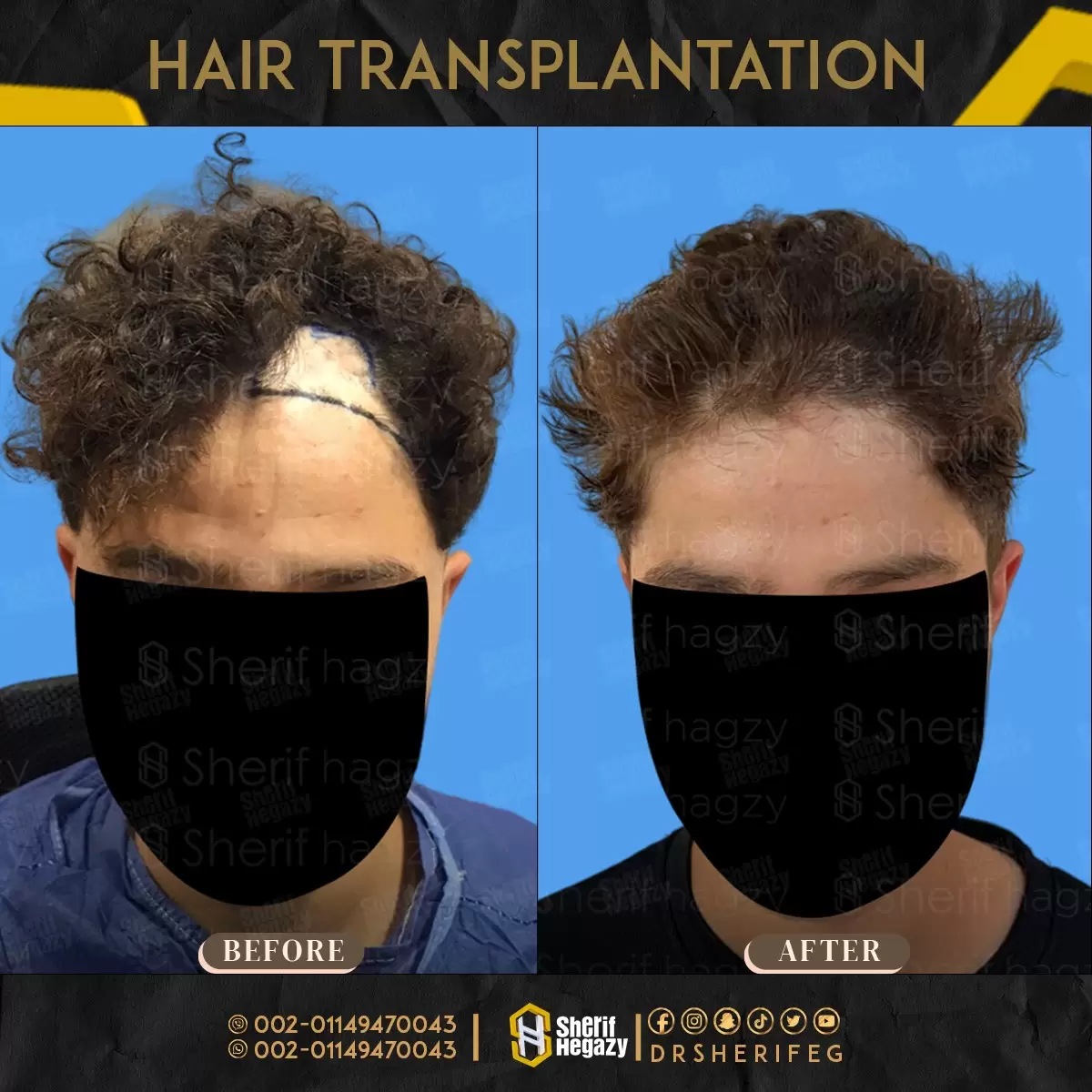 زراعة الشعر للحروق