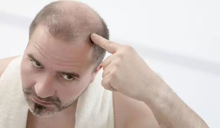 زراعة الشعر للرجال