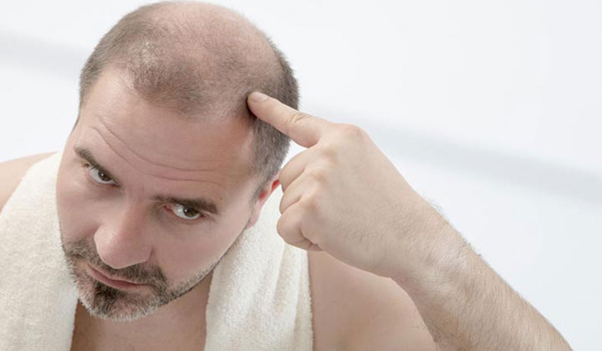 زراعة الشعر للرجال