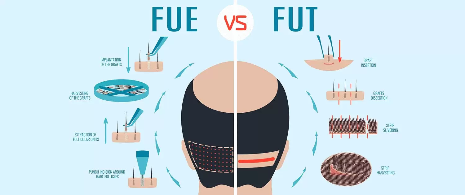زراعة الشعر للرجال