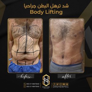 الانتفاخ بعد عملية شد البطن