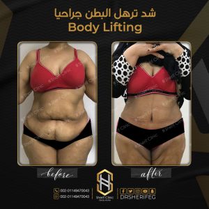 عملية شد البطن بالصور