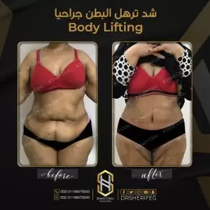 لبس المشد بعد عملية شد البطن