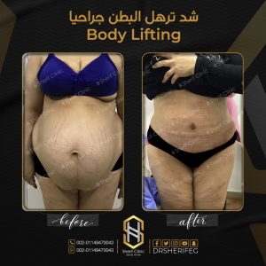 ترهلات الجسم بعد فقدان الوزن