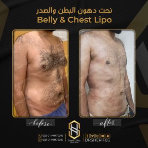 الاثار الجانبية لعملية شفط الدهون