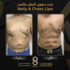 شفط الدهون بالليزر