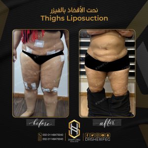 تنحيف الافخاذ