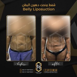 تحجر البطن بعد عمليه شفط الدهون